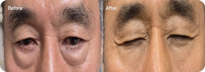 눈밑 필러 후기