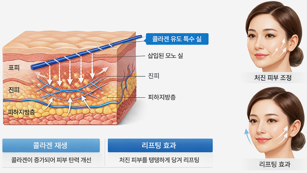 모노매선의 원리