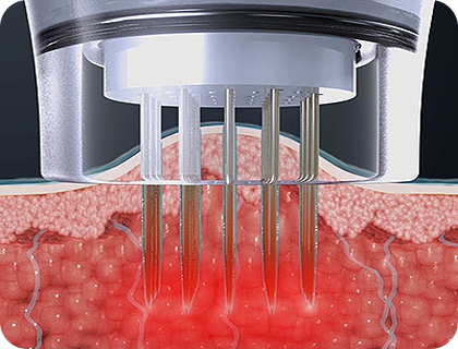 고주파 에너지 발생