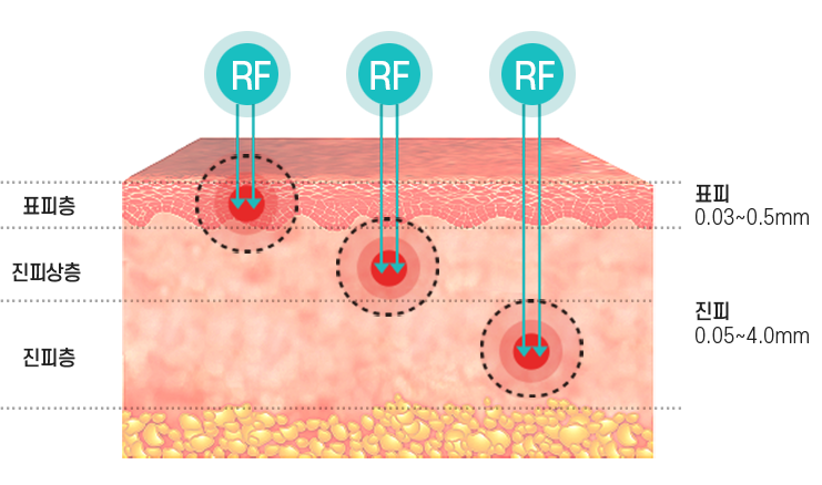 다양한 깊이에 시술 가능