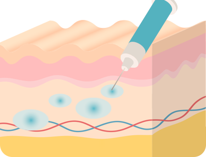 리쥬란힐러 시술