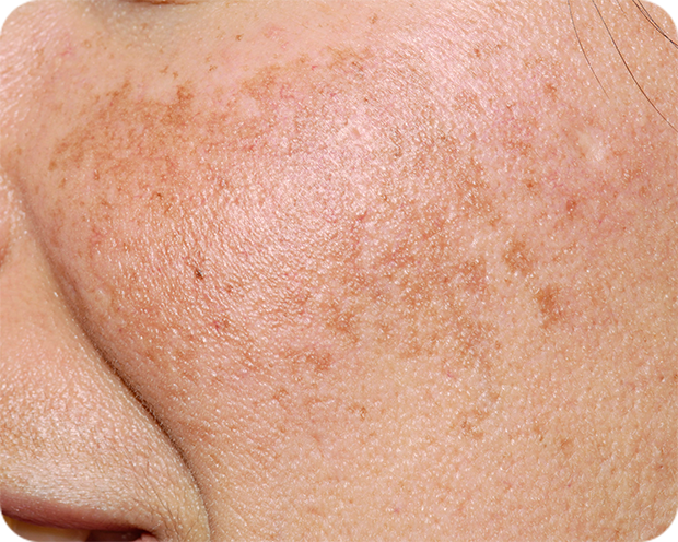 잔주름이 많고 피부결이 거친 경우
