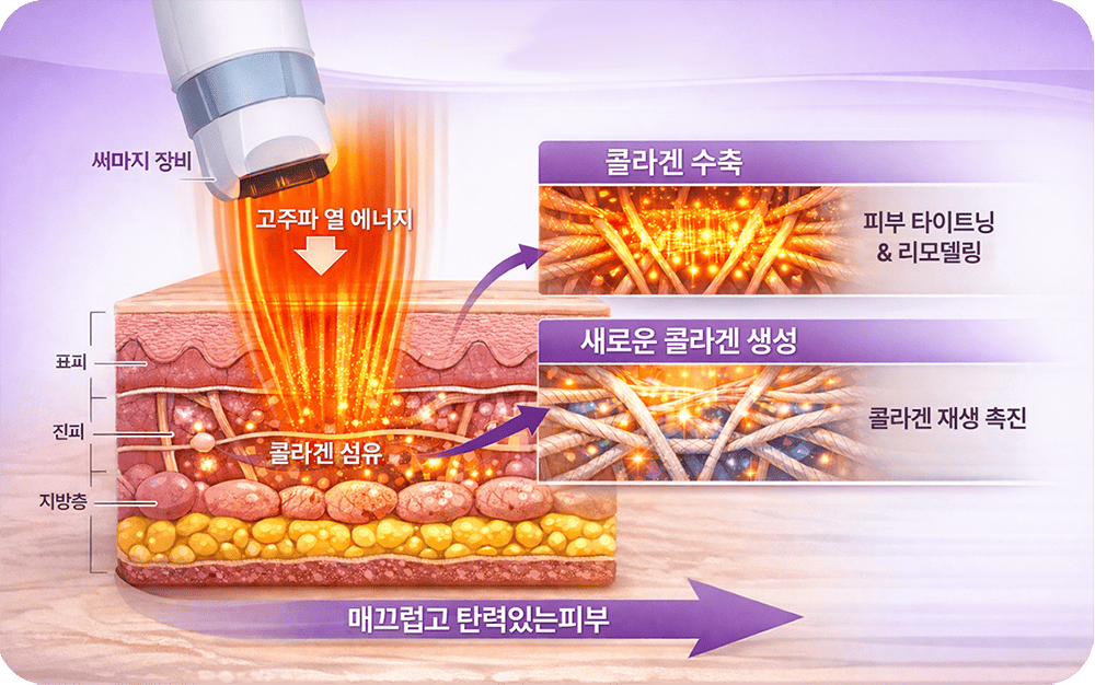 써마지 CPT의 원리